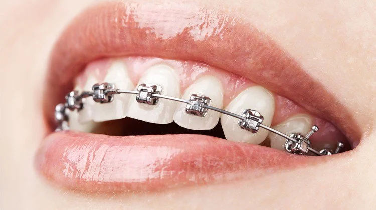Niềng răng mắc cài là gì? Ưu và nhược điểm của niềng răng mắc cài niềng răng