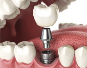 Trồng răng Implant là gì?- Những điều cần biết về Implant 875db679345499.Y3JvcCwxMjI3LDk2MCwzMTIsMA