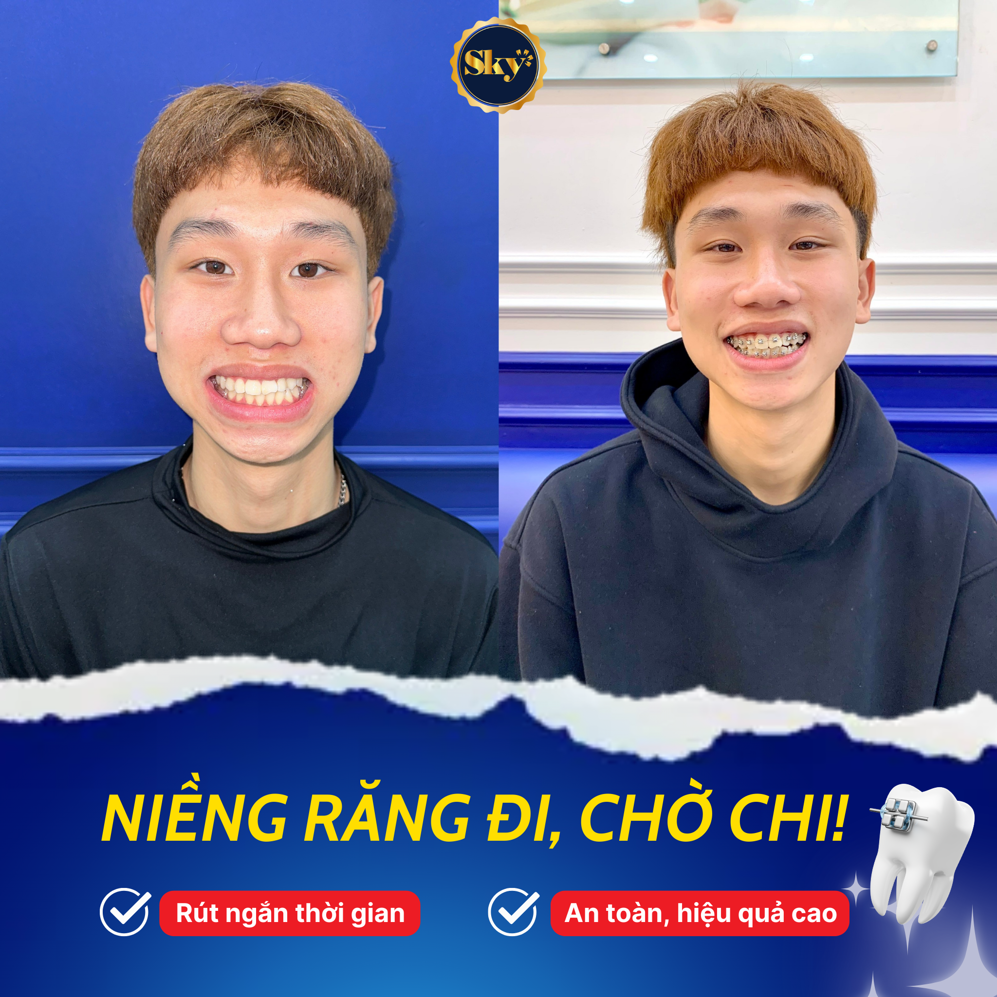 Niềng răng mắc cài là gì? Ưu và nhược điểm của niềng răng mắc cài Khach nieng rang 3