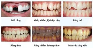 Bọc răng sứ thẩm mỹ Nhung tinh trang can lam rang su