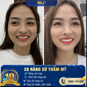 Bọc răng sứ thẩm mỹ Rang su Sky 1