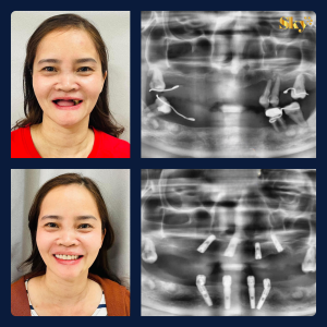 Trồng răng Implant là gì?- Những điều cần biết về Implant Thiet ke nha khoa 24