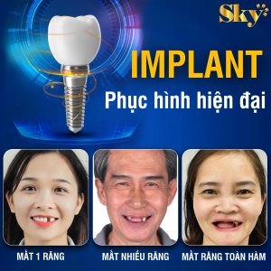 Trồng răng Implant là gì?- Những điều cần biết về Implant XaA123