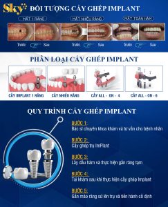Trồng răng Implant là gì?- Những điều cần biết về Implant sky