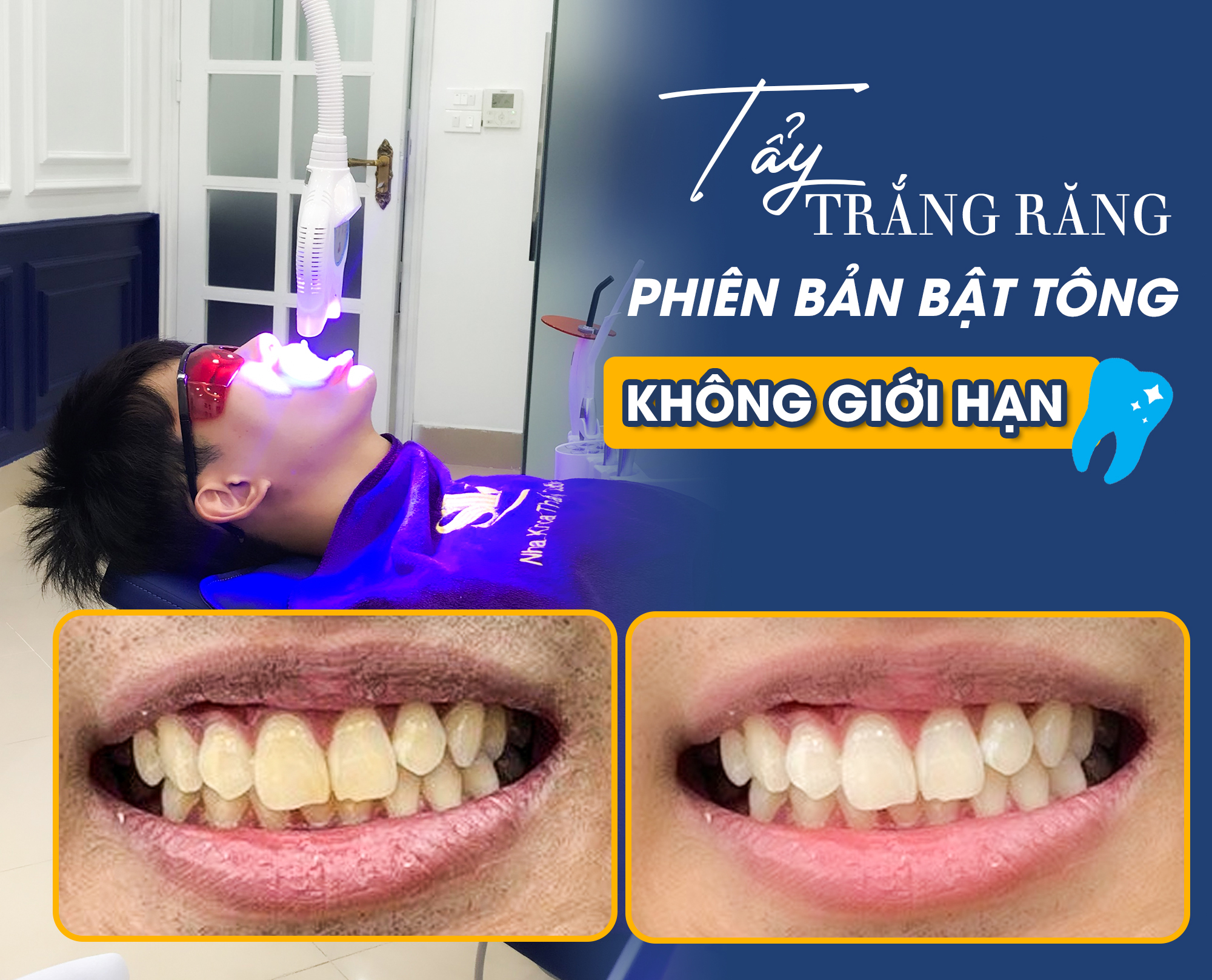 Tẩy trắng răng là gì? tay trang rang