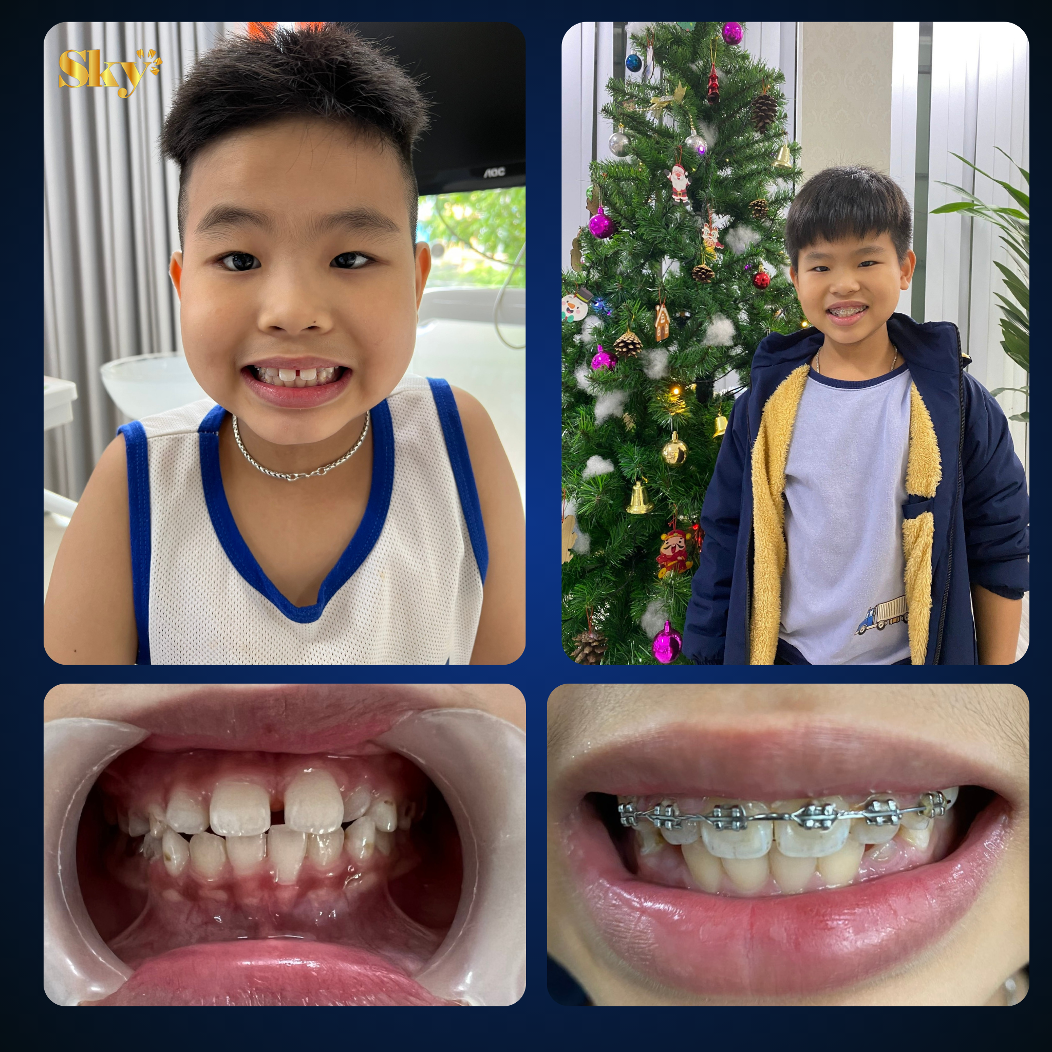 Niềng răng mắc cài là gì? Ưu và nhược điểm của niềng răng mắc cài NIENG RANG 14