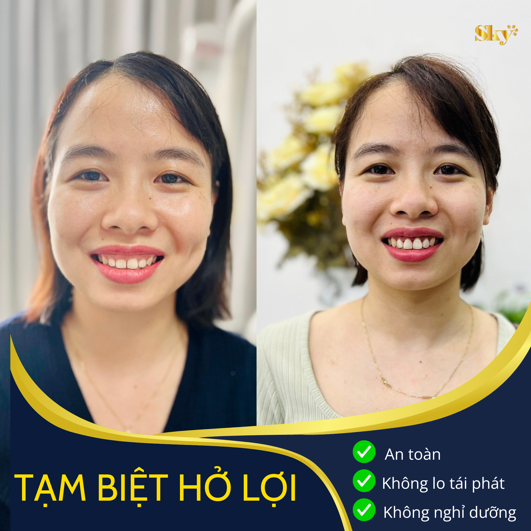 Điều trị cười hở lợi an toàn, không tái phát! Thiet ke nha khoa 36