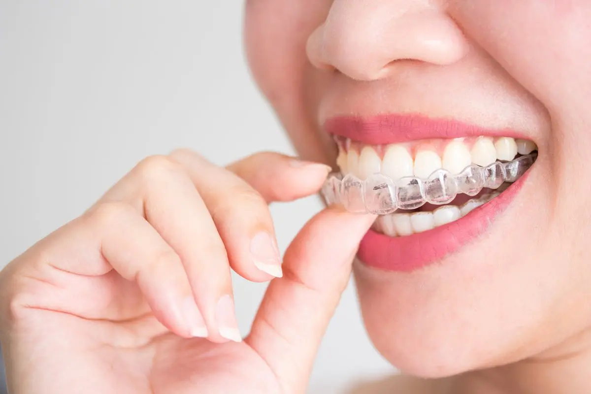 Niềng răng trong suốt là gì? Có nên niềng răng trong suốt Niềng răng trong suốt